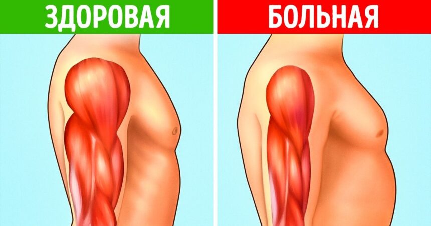 Терапевтическое лечение дистрофии мышц стволовыми клетками