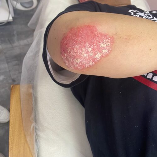 Быстрое и эффективное лечение псориаза